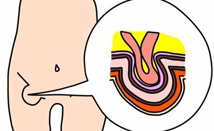 Abbildung Bauchwandbr&uuml;che (Bereich Hernien-Chirurgie)