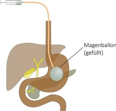 https://www.klinikum-dresden.de/fileadmin/user_upload/zentren___bereiche/neustadt_trachau/adipositaszentrum/magenballo0n2.jpg
