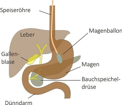 https://www.klinikum-dresden.de/fileadmin/user_upload/zentren___bereiche/neustadt_trachau/adipositaszentrum/magenballon.jpg
