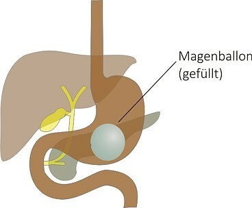 https://www.klinikum-dresden.de/fileadmin/user_upload/zentren___bereiche/neustadt_trachau/adipositaszentrum/magenballon3.jpg